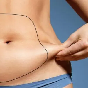 tummy-tuck-scar-revision-surgery – Cosmetic Surgery Sri Lanka. Safe,  Affordable. Experienced, Qualified & Licensed Plastic Surgeons and Dentists.