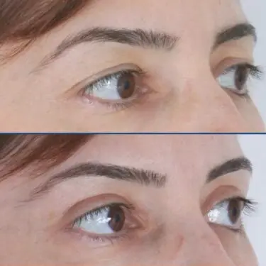 Blepharoplastik