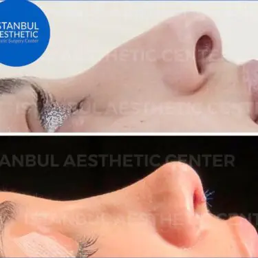 Rhinoplastik