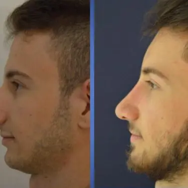 Rhinoplastik