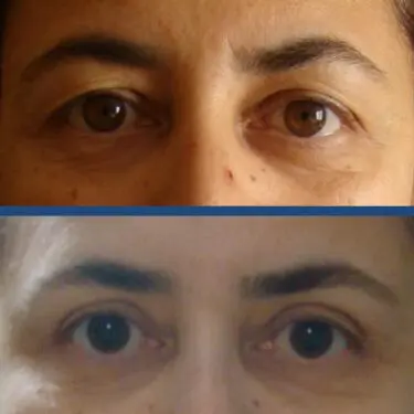Blepharoplastik