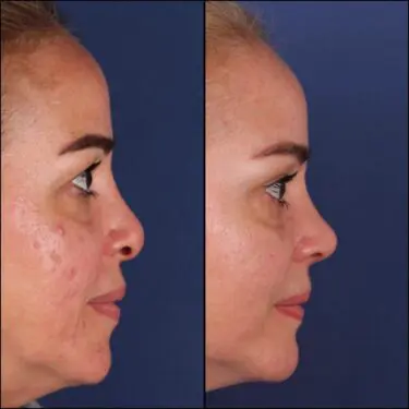 Rhinoplastik