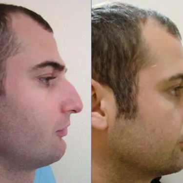 Rhinoplastik