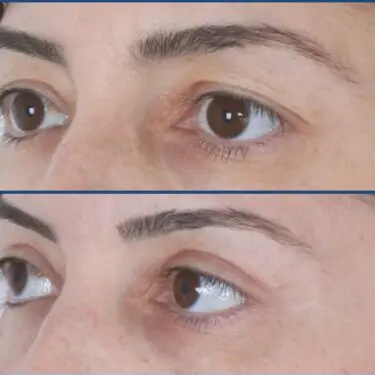 Blepharoplastik