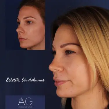 Rhinoplastik