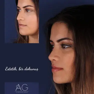 Rhinoplastik