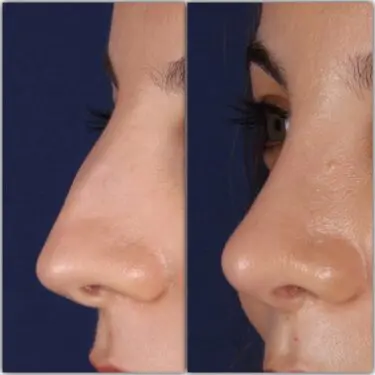Rhinoplastik