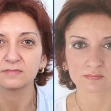 Blepharoplastik