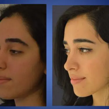 Rhinoplastik