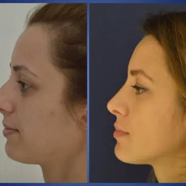 Rhinoplastik