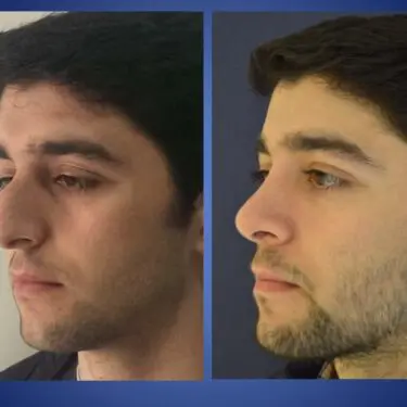 Rhinoplastik