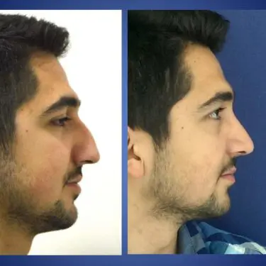 Rhinoplastik