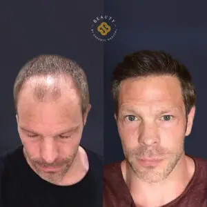 DHI hair transplant by Oya Shishman in Turkey
