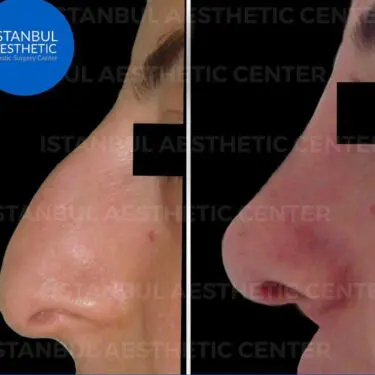 Rhinoplastik