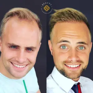 DHI hair transplantation by Oya Şişman in Turkey