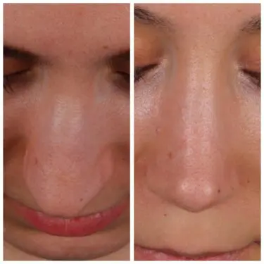 Rhinoplastik