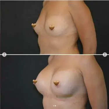 Mammoplasty