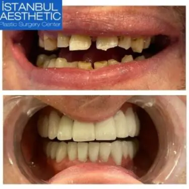 Aesthetic dentistry in Turkey