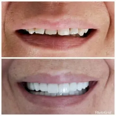 Aesthetic dentistry in Turkey