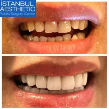 Aesthetic dentistry in Turkey