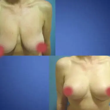 Mammoplastik
