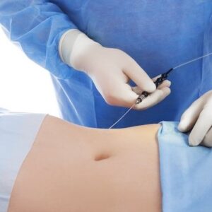 Laser liposuction in Turkey