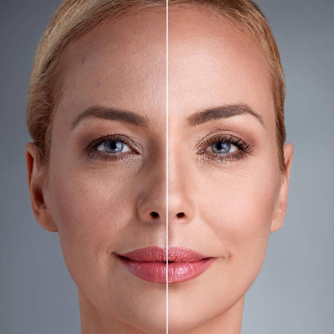 Rejuvenation and facial correction