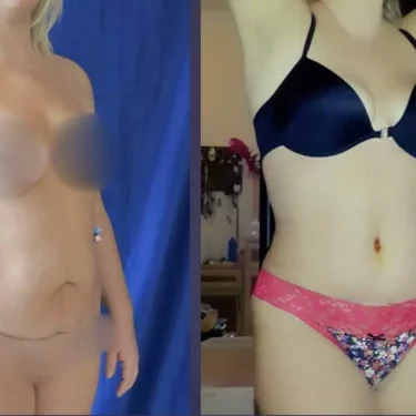 Liposuction + abdominoplasty