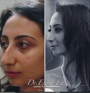 rhinoplasty in Istanbul aesthetic