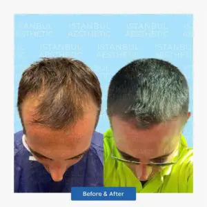 hair transplantation in istanbul aesthetic