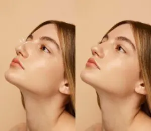 rhinoplasty in Istanbul aesthetic