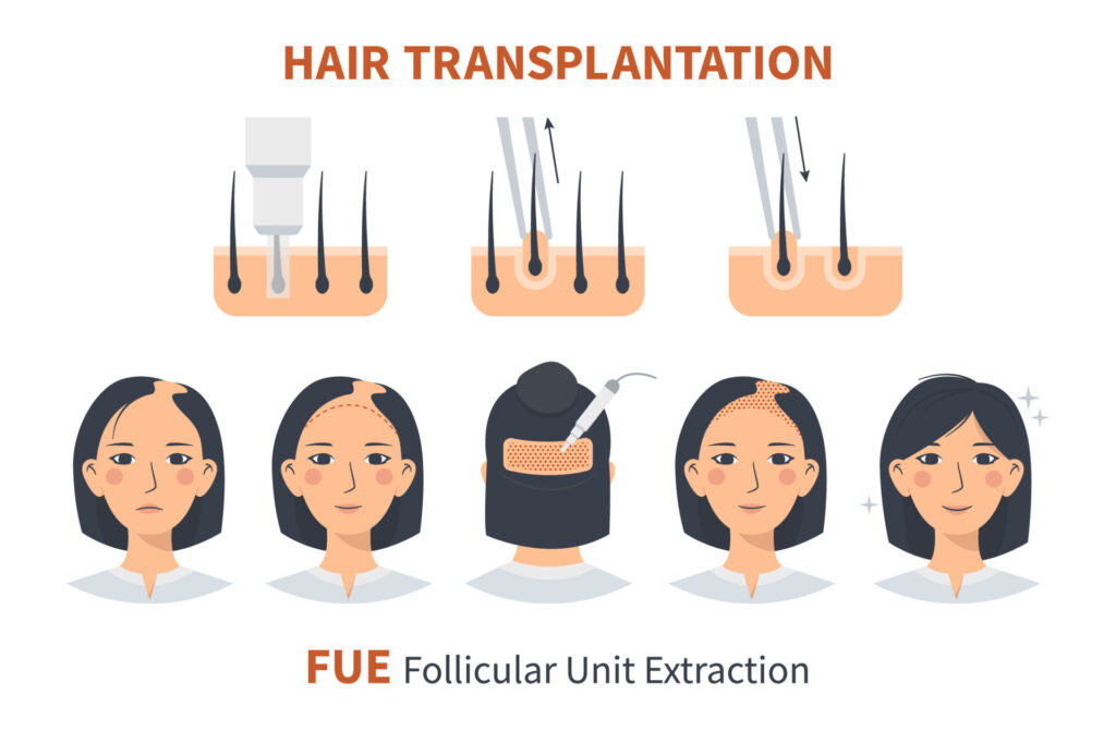Методи пересадки волосся у Туреччині: FUE