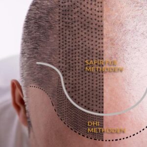 Пересадка волос в Турции: Метод FUE и Метод DHI - отличия