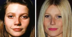 rhinoplasty before and after