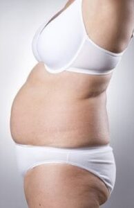 liposuction of the abdomen in Turkey
