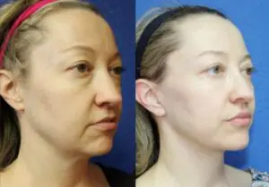 омолодження нитками