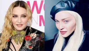 фото до та після підтяжки обличчя