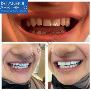 Aesthetic dentistry in Turkey