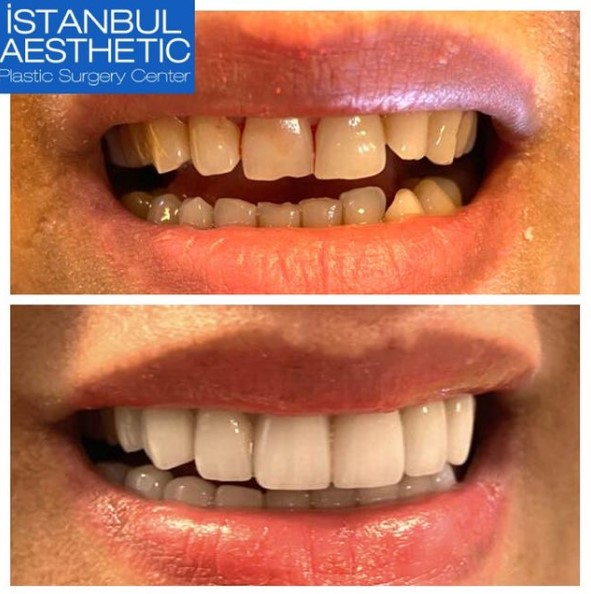 Implantes dentales en Turquía