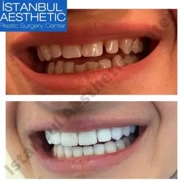 Aesthetic dentistry in Turkey
