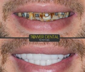 Имплантация зубов в Турции