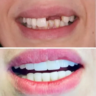Implantes dentales en Turquía
