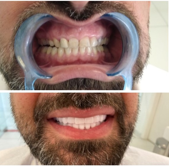 Імплантація зубів у Туреччині