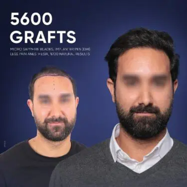 DHI Hair Transplant in Turkey