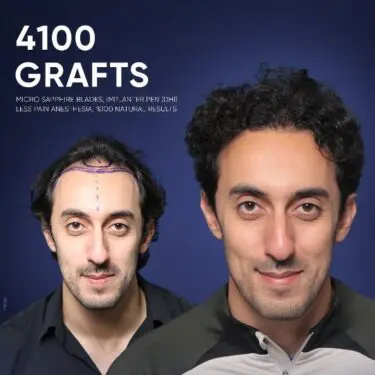 DHI Hair Transplant in Turkey