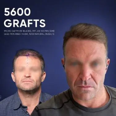 DHI Hair Transplant in Turkey