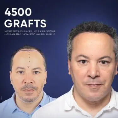 DHI Hair Transplant in Turkey