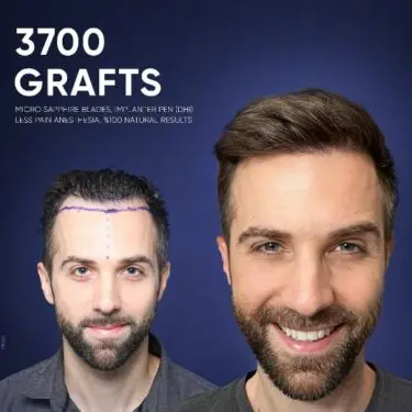 DHI Hair Transplant in Turkey