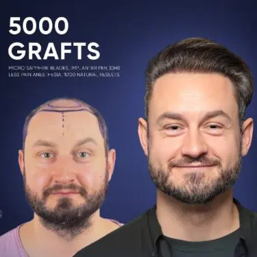 DHI Hair Transplant in Turkey