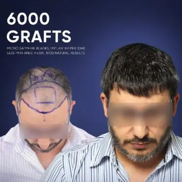 DHI Hair Transplant in Turkey
